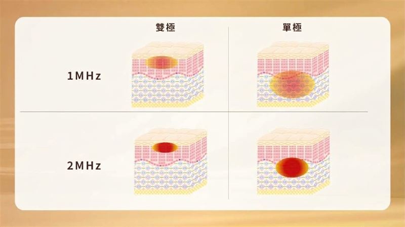 單極電波進行深層容積式加熱、加固底層結構,雙極電波改善淺層細紋,由深至淺、由內而外達到「一台抵多台」的量身客製化療效。(圖/業者提供)