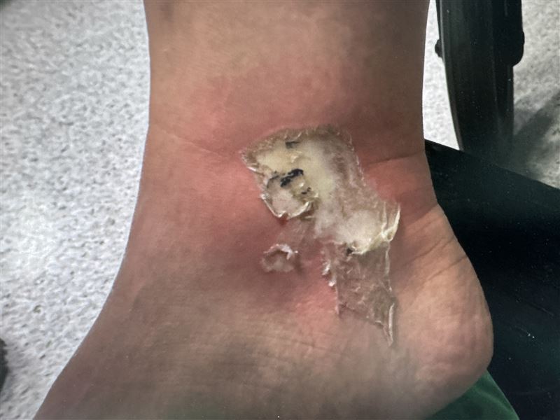 三度燒燙傷會傷及真皮層,傷口可能呈蠟白、棕色、焦黑或皮革狀,因神經末梢受損,可能只有輕微疼痛甚至不痛,通常難以自行癒合,常需清創及植皮治療。(圖/烏日林新醫院提供)