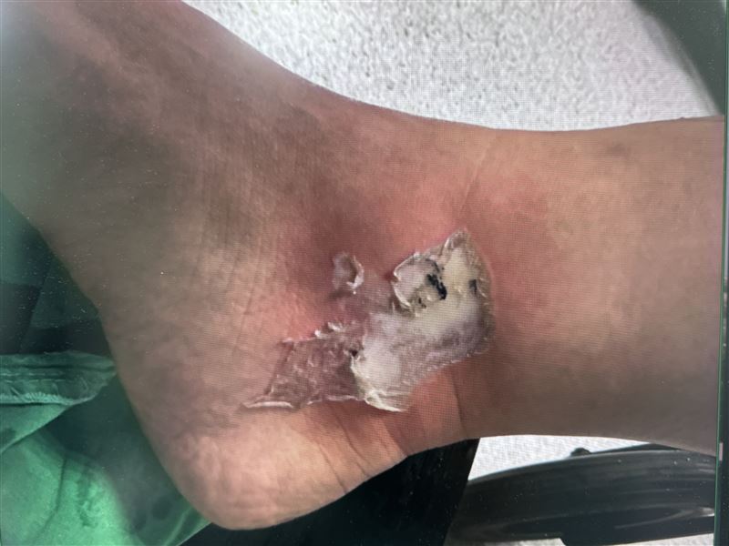 三度燒燙傷會傷及真皮層,傷口可能呈蠟白、棕色、焦黑或皮革狀,因神經末梢受損,可能只有輕微疼痛甚至不痛,通常難以自行癒合,常需清創及植皮治療。(圖/烏日林新醫院提供)