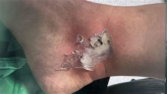 25歲女車禍！腳踝慘遭排氣管三度深層燙傷