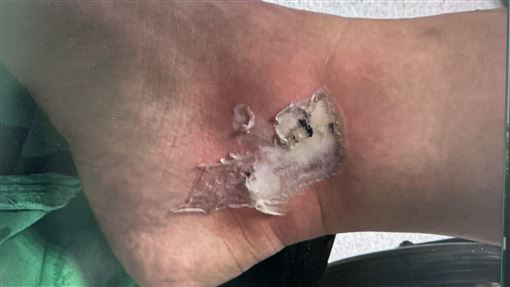 25歲女車禍！腳踝慘遭排氣管三度深層燙傷