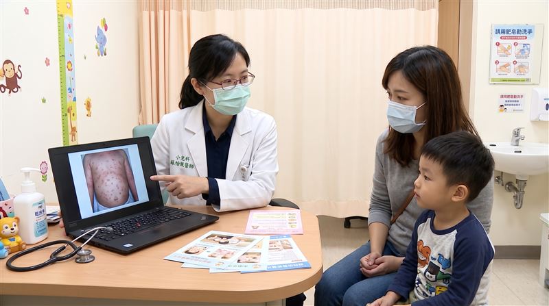 腸病毒疫情持續發威，兒科醫師蘇怡甄收治一名4歲男童，腹部與四肢長滿密集水泡，且完全沒有發燒。（示意圖／AI生成）