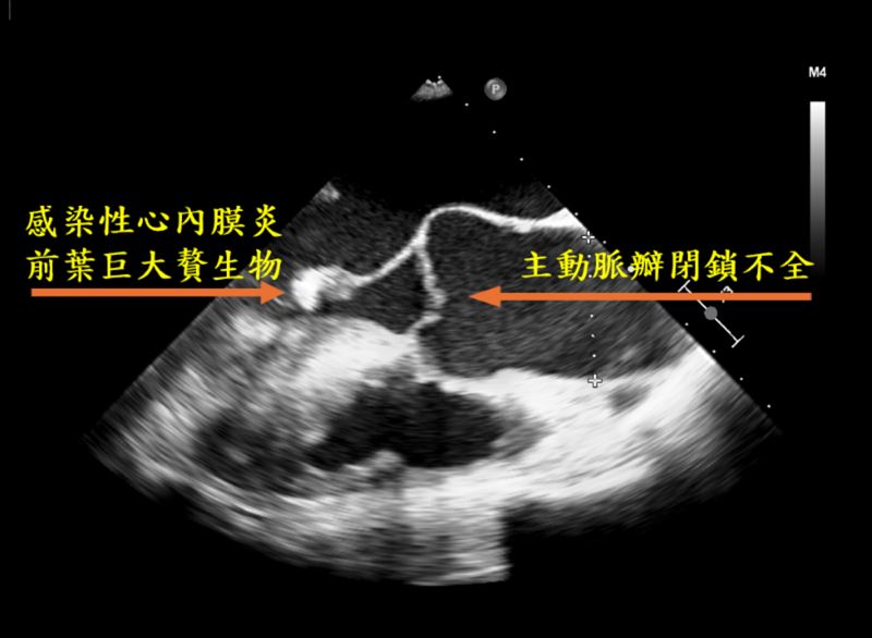 圖為經食道心臟超音波影像,標示處可見主動脈瓣膜閉鎖不全,及因心內膜炎造成的贅生物。(圖/台北慈濟醫院提供)