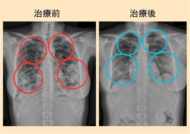 病人經檢查發現,雙側肺部有廣泛性浸潤(左),經治療後順利改善(右)。(圖/大千醫院提供)