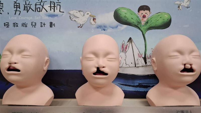 得知胎兒唇顎裂　名師曝1關鍵：85％留