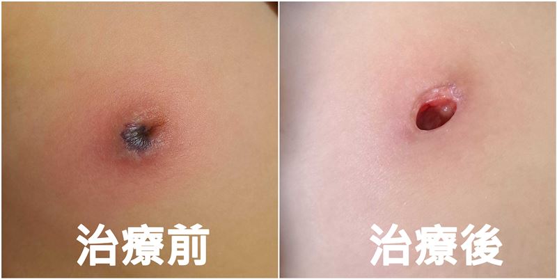 國小女童因抓傷不慎感染綠膿桿菌，導致乳頭凹陷。（圖／亞大醫院提供）