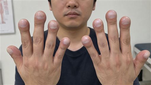 指甲胖如棒棒糖！3病因曝 恐是心臟病警訊