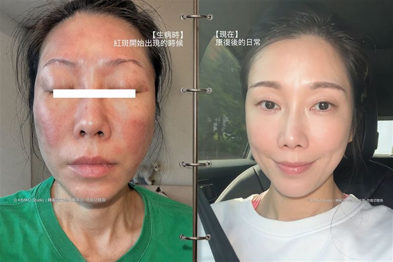 KIMIKO一度嚴重過敏。(圖/翻攝自KIMIKO臉書)