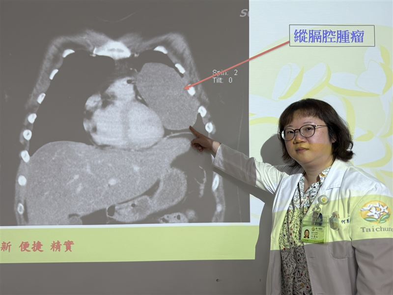 台中24歲妙齡女求職健檢，意外發現左側胸腔長了15公分巨大腫瘤。（圖／台中醫院提供）
