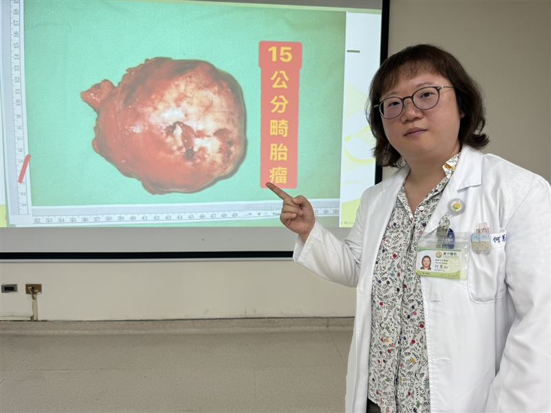 女子左側胸腔內長出15公分畸胎瘤，幾乎與心臟一樣大。（圖／台中醫院提供）
