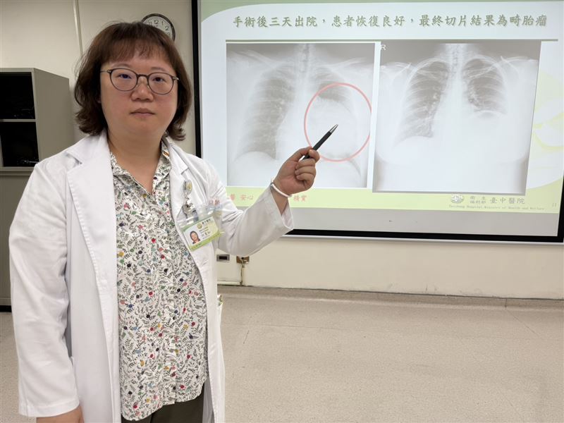台中24歲妙齡女求職健檢，意外發現左側胸腔長了15公分巨大腫瘤。（圖／台中醫院提供）