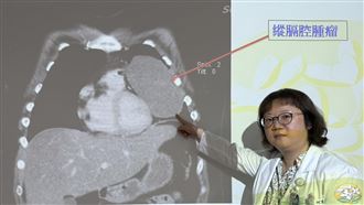 肺被壓扁竟無感！24歲女胸腔長15公分腫瘤
