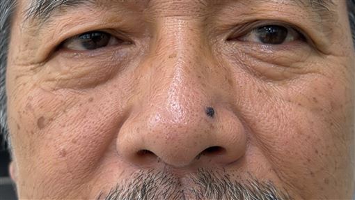 男不理鼻上黑痣 搭捷運被提醒 竟是皮膚癌