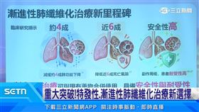 重大突破! 特發性肺纖維化治療新選擇