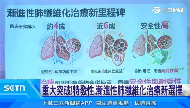 重大突破! 特發性肺纖維化治療新選擇