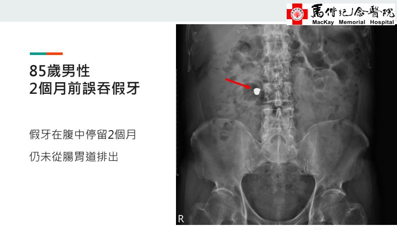 醫師說明個案假牙(紅箭頭)掉入腸道憩室。(圖/馬偕醫院提供)
