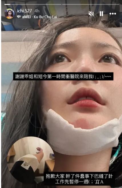 怡琪公開一張受傷照片,透露自己騎乘Ubike時不慎發生摔車意外。(圖/翻攝自IG)