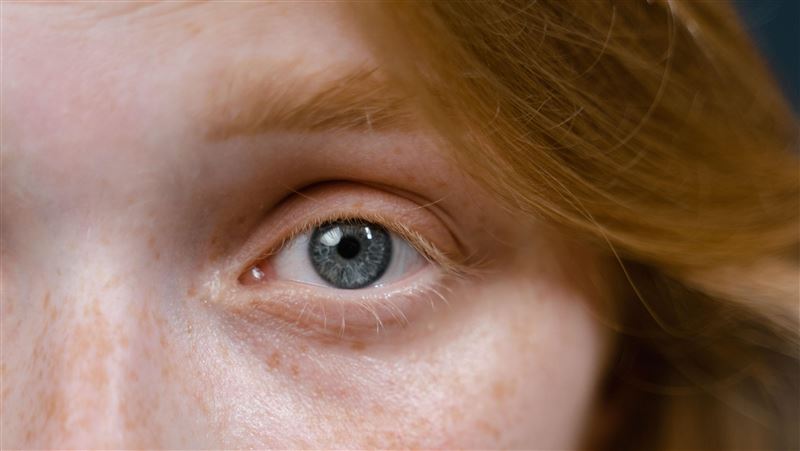 眼周冒白顆粒「不是粉刺」！醫警：別硬擠