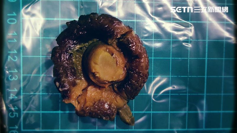 肚子痛竟是腸阻塞…剖腹取出「整朵香菇」