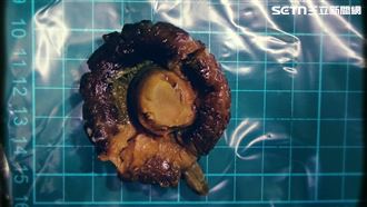 肚子痛竟是腸阻塞…剖腹取出「整朵香菇」