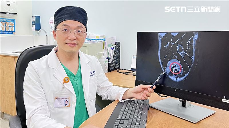 一般及消化系外科醫師蘇文隆表示,香菇、金針菇、筍乾、糯米製品等,在腸道狹窄處或蠕動較差的部位就容易聚積、卡住,進而形成團塊,導致腸道完全閉鎖、腹脹、腹痛與嘔吐。(圖/翻攝畫面)