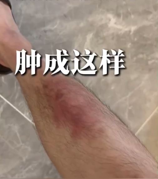 林正峰為了爭取演出機會，自費報名拳擊與武打課程，苦練到整隻腳紅腫。（圖／翻攝自微博 @林正峰_Niklas）