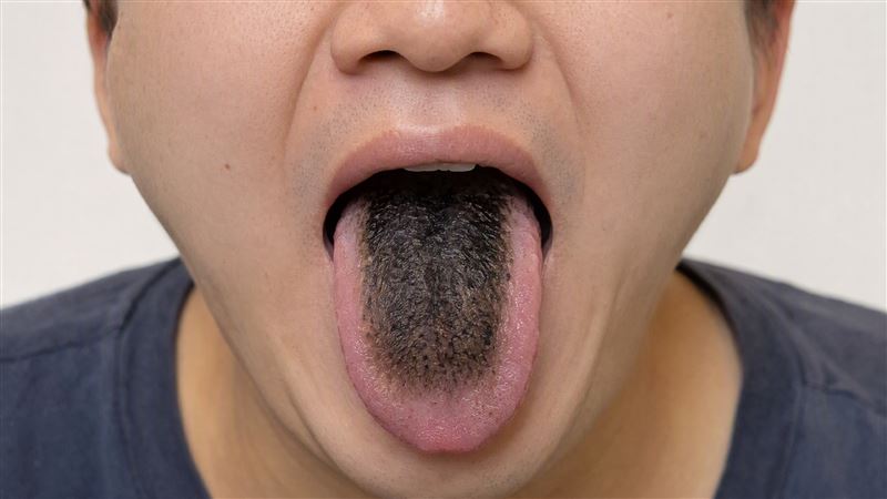 60歲男舌頭突變黑、表面毛茸茸，嚇得就醫，竟與近期服用抗生素有關。（示意圖／AI製圖）