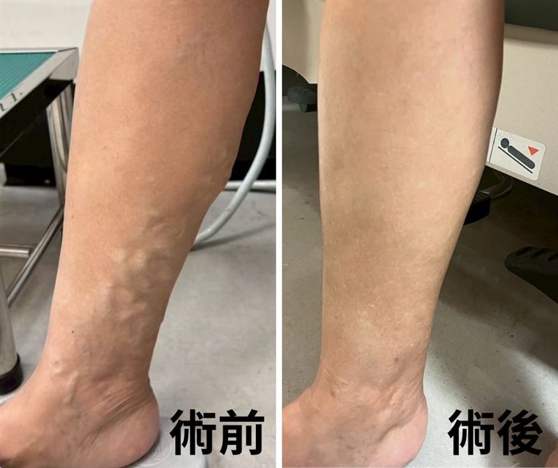 68歲婦人右小腿出現靜脈曲張已超過30年,直到最近突腫脹疼痛,才去接受治療,治療後疼痛消失,小腿外觀也變平整。(圖/長安醫院提供)