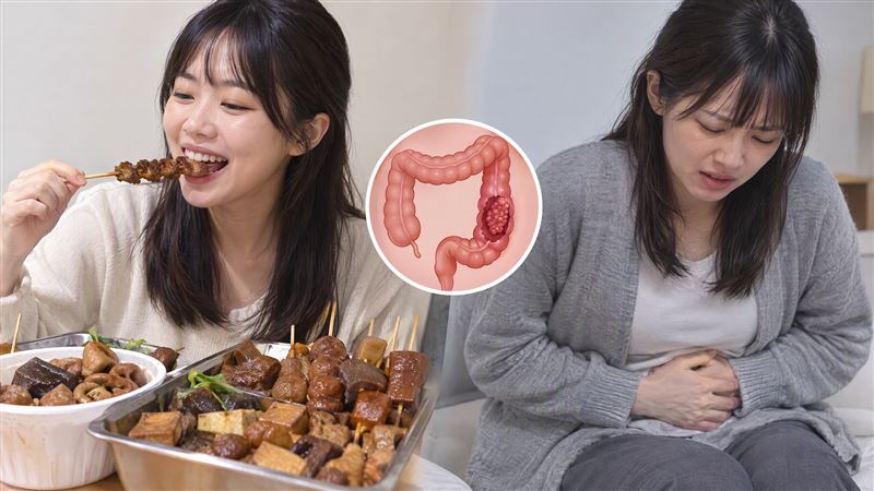 大腸直腸肛門外科醫師黃郁純分享,一名30歲女子無腹痛、血便,檢查卻發現大腸腺瘤,提醒年輕族群也應重視腸道健康。(示意圖/AI製圖)