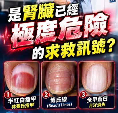 醫師洪永祥列舉3種常見的腎衰竭警訊,包括半紅白指甲、博氏線指甲、月牙消失的指甲。(圖/取自洪永祥的臉書)