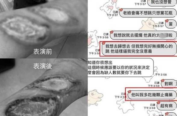 &nbsp;A小姐在職期間因車禍導致腿部有三級燒燙燒，卻被強逼上工，團長甚至要求她「多吃幾個止痛藥就好」。（圖／民眾提供）